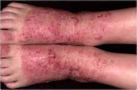 Cacar air adalah penyakit infeksi yang disebabkan oleh virus varicella zooster, yang bisa menyerang siapa. Bintik merah gatal pada telapak tangan dan kaki | Macam ...