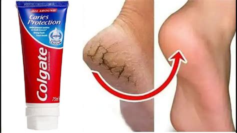 Jul 14, 2014 · use one daily or once every other day; Remove Cracked Heels and Get soft Feet - Homemade Magical ...