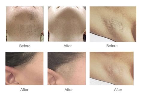 808nm Diode Laser Hair Removal Equipments For Sale ...