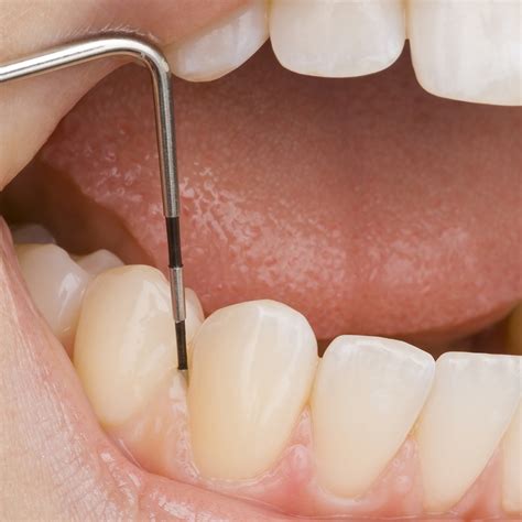 The bacteria colonize along and under the gum line and eat (yes eat) living tissue, including gum tissue, bone and ligament that. Periodontal Therapy - Periodontitis & Bone Loss