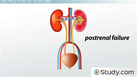 Acute renal failure is increasingly common, particularly in elderly people, although reported incidences vary according to the definition used and the population studied. Acute Renal Failure - Postrenal Failure & How It Alters ...