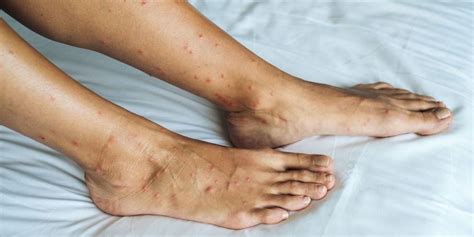 Munculnya bintik merah pada kulit bisa disebabkan oleh beberapa kondisi. Gatal Di Kaki Dan Berair - Rajiman