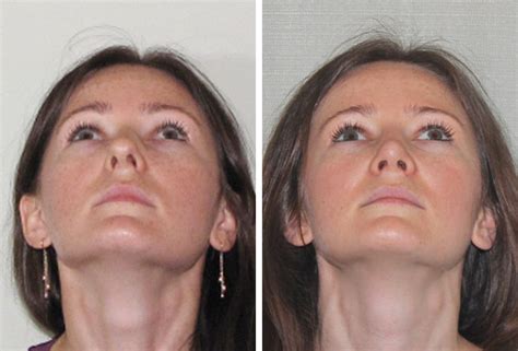 Some displacement is common, affecting 80% of people, mostly without their knowledge. Does Insurance Cover Rhinoplasty Deviated Septum : Rhinoplasty Minneapolis Revision Rhinoplasty ...