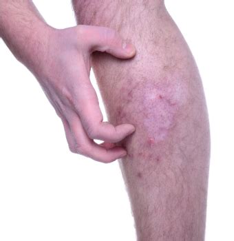 Itching skin or pruritus can be caused by any number of conditions. Itchy Lower Legs - Causes, Red Rash, How To Get Rid ...