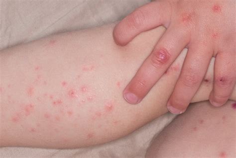 Segno clinico tipico è la comparsa di petecchie, piccole macchioline rosse che compaiono dopo sforzo. Геморрагический васкулит: причины, диагностика, лечение