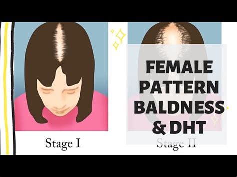 The main reason that hair loss is reversible is that male pattern baldness is not natural. Female pattern baldness | DHT hair loss| how to treat ...