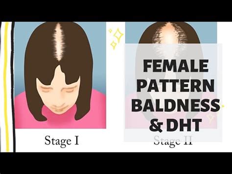 The main reason that hair loss is reversible is that male pattern baldness is not natural. Female pattern baldness | DHT hair loss| how to treat ...