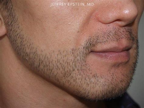 Before and after 2100 fue grafts to the beard. Facial Hair Photos | Miami, FL | Patient 36912