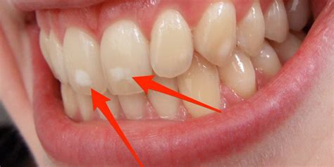 What causes white spots on teeth after braces? Protect Your Smile From White Spots | Oral and ...