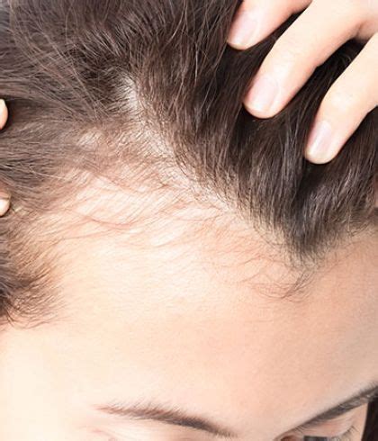 The procedure takes just about 30 minutes once a week and the results are visible. Does dengue fever cause hair loss? | Dr Batra's™