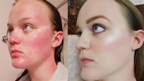 Sunburn signs and symptoms usually appear within a few hours after sun exposure. See how this women masterfully covered her sunburn with ...