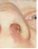 It may be secondary to chronic rhinorrhea, nose picking or viral infections. Inflammation nasal vestibulitis - Hearing Loss