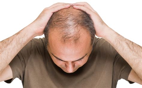 Notamment lors de la grossesse et de la ménopause, où, là aussi. Les Causes de la Perte des Cheveux Chez Les Hommes