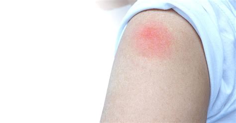 An angry red rash being called covid arm is a harmless but annoying response in some people who get the. Allergic reactions to COVID-19 vaccines shouldn't stop ...