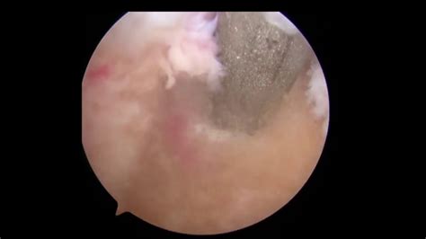 Greater Tuberosity Avulsion Fracture | Arthroscopic ...