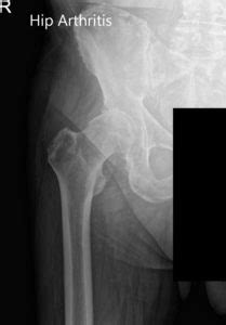 Find affordable health insurance plans in new york. Case Study: Primary Total Hip Arthroplasty in an 84-year-old female for Hip Arthritis | Complete ...