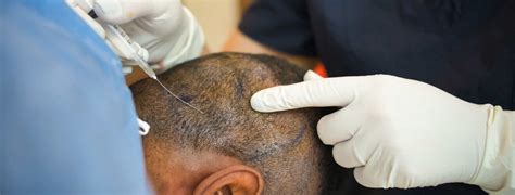 11 best clinics for afro hair transplant in turkey. Afro Hair Transplant in Turkey | Yetkin Bayer