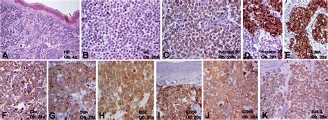 As a result, they are classed as neuroendocrine cells, and mcc, in turn, is sometimes called neuroendocrine carcinoma of the skin. Microscopically, the Merkel cell carcinoma is ...