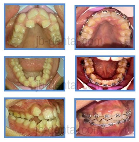 Guru dengan gigi berantakan, gigi maju, & bibir tebal dirawat behel gigi oleh dokter gigi jogja. gigi bergelombang Archives - JB Dental Klinik