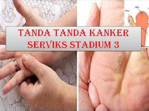 Invasive breast cancer means that the cancer cells have grown through the lining of the ducts into the surrounding breast tissue. tanda tanda kanker serviks stadium 3 - YouTube