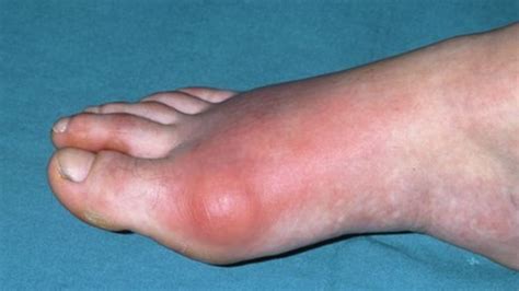 Symptoms and treatment | the hand society. Rates of gout in UK 'soaring' - BBC News