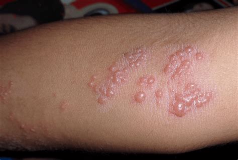 Pemphigus and fogo selvagem symptoms, causes, diagnosis, and treatment information pemphigus and fogo selvagem is listed as a rare disease by the office of rare diseases (ord) of the national. Fogo Selvagem ou Pênfigo - Doença Que Causa Formação de ...