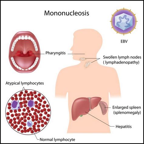 Mononucleosis has different degrees of symptoms in infants, young children, teens, and adults. Mononucleosis - Minhhai2d Help Doctor