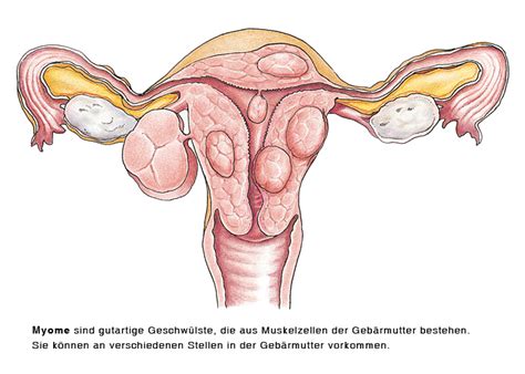 Oftmals sind diese jedoch zu groß, sodass sie unästhetisch nach. Gutartige Tumoren der weiblichen Geschlechtsorgane - eesom ...