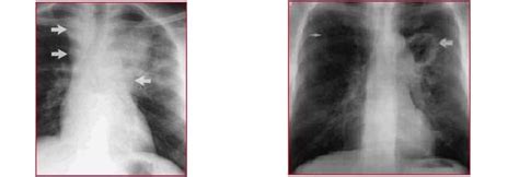Im röntgenbild ist tuberkulose meist gut erkennbar: Tuberkulose, Test, Anzeichen, Dauer, Folgen, Heilung ...