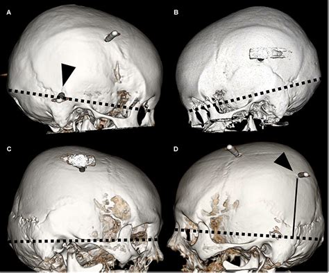 A slipped disc occurs when the gel covering a disc in the spine herniates and shifts. Full text Estimation of Risk Factors for Head Slippage ...