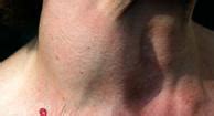 While the sizes of breast cancer lumps vary from case to case depending on the stage of the disease, what what does cancer lump feel like in neck? Neck Lump: 37 Causes, Treatments & Pictures