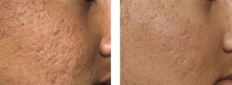 We did not find results for: micro_needling_akne_vorher_nachher - Micro Needling