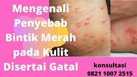 Saraf terjepit, multiple sklerosis, diabetes, atau bisa juga karena terkena herpes zoster. Mengenali Penyebab Bintik Merah pada Kulit Disertai Gatal ...