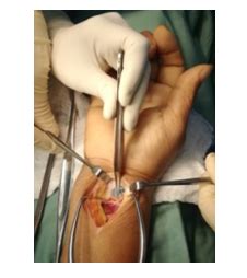 At 4 hours postoperatively there is a drop from 33 degrees celsius to 29 degrees celsius and the pulse oximetry monitor on the thumb reads 87%. Flexor Pollicis Tendon Rupture After Volar Plating of ...