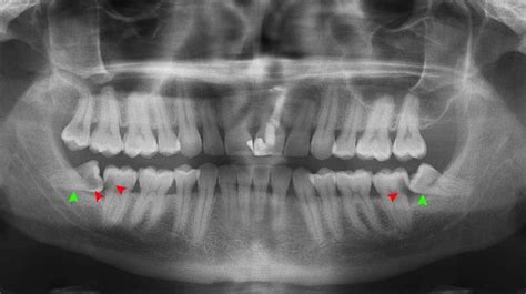 Cavities can occur in any teeth but are most common in the molars. How Long Do Wisdom Teeth Take To Come Through Fully ...