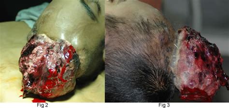 Brain tumor diagnosis in children Cancer Centers: What Are The Symptoms And Stages Of a ...