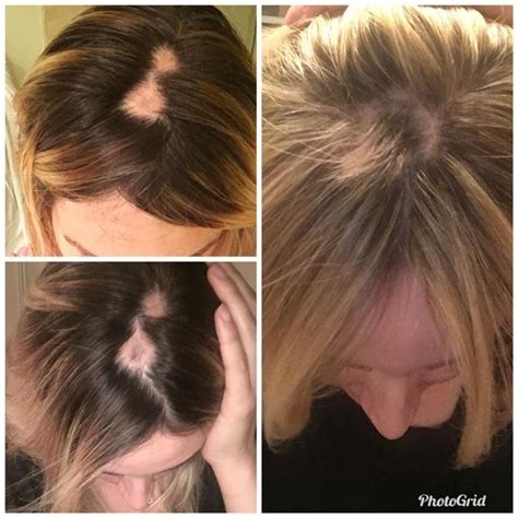 Other treatments for hair thinning or loss range from taking hair skin and nail supplements, which may not offer substantial results, or otc there are a few exceptions you should note. Effectiveness Of Steroid Injections For Hair Growth ...