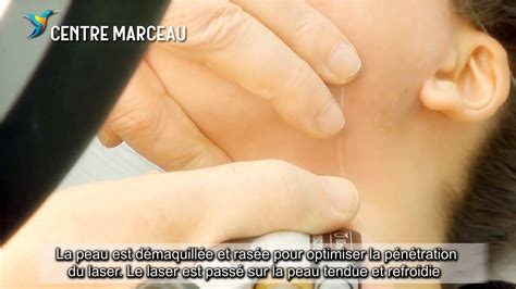 Pour une épilation rapide, efficace et selon votre teint de peau, cet épilateur laser a su. Epilation laser du visage - Centre Marceau Paris - YouTube