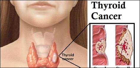 Follicular thyroid cancer makes up between 10% and 15% of all thyroid cancers in the united states. Thyroid Cancer Disease - What It Is, Symptoms And Treatments