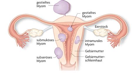 Zur behandlung von geschwollenen beinen kombiniert die naturheilkunde verschiedene ansätze. Blutungen außerhalb der Regel: Myome, Polypen ...