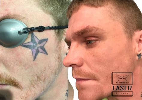 Apr 03, 2021 · the nhs rarely carries out tattoo removal, as it is normally considered a cosmetic procedure. Laser Tattoo Removal - Whiteroom Laser Ltd