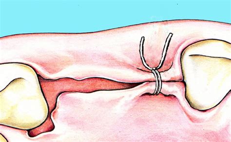 For tricuspid valve replacement (tvr), intermittent mattress suture was also employed, and fixing with artificial annular ring and intermittent. Laurell-Gottlow suture modified by Sentineri for tight ...