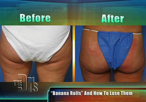 After liposuction, fluid can build up under the skin near the surgery site causing swelling. Banana Roll Solution - Liposuction to Remove Buttock Fat - AHB