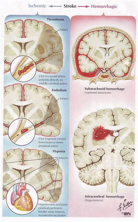 Ais ϭ acute ischemic stroke; النشبة (السكتة) الدماغية: إحتشائية أم نزفية؟ - Stroke ...