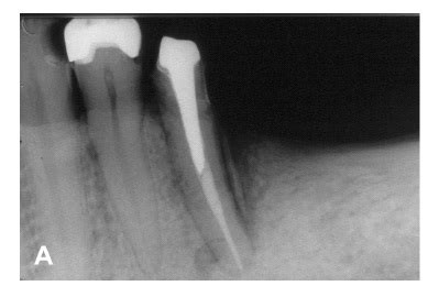 Cemental tears often show characteristics mimicking a periapical or periodontal lesion. Cemental tear: a case report with nonsurgical periodontal ...