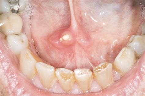 Check spelling or type a new query. Salivary gland stones - NHS