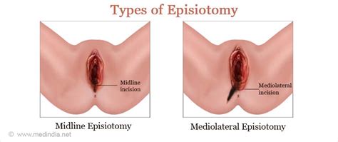 • redness and swelling in the area of the stitches. All You Need To Know About Episiotomies - Parents Avenue