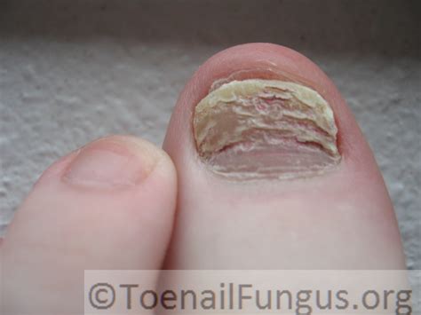 Some are more effective than others, and some are more natural it should be reasonably easy to spot the difference between trauma and fungus. February 26, 2019 - Toenail Fungus