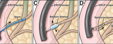 Benign biliary strictures related to chronic pancreatitis: How Should We Treat Recurrent Acute Pancreatitis? | AGA ...