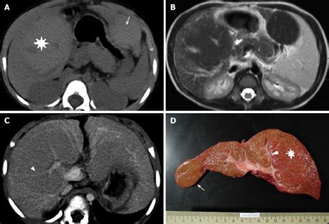The causes of biliary atresia are not completely understood. Macro-regenerative nodules in biliary atresia: CT/MRI ...